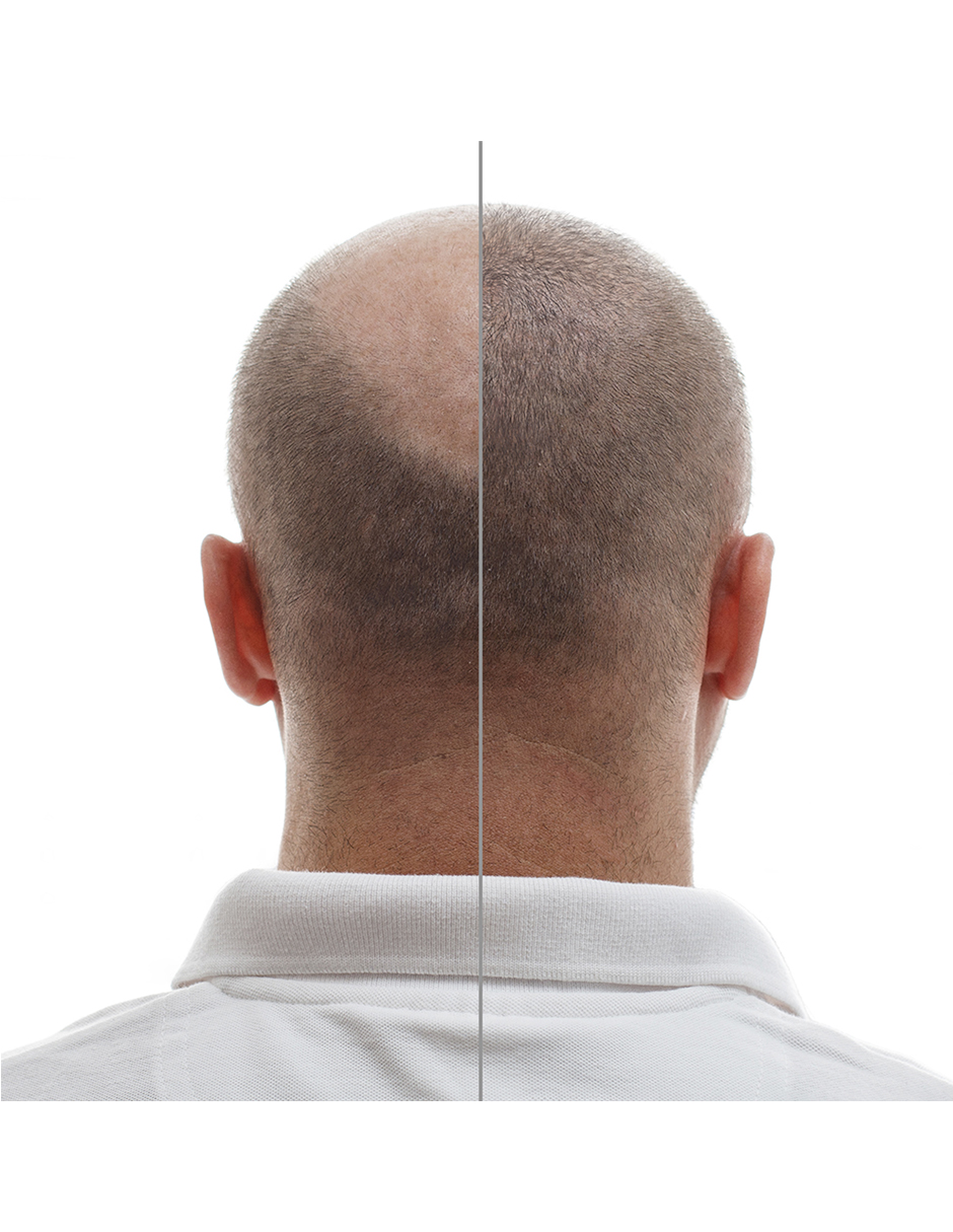 Minoxidil Pastillas 5mg Oral Minoxytop